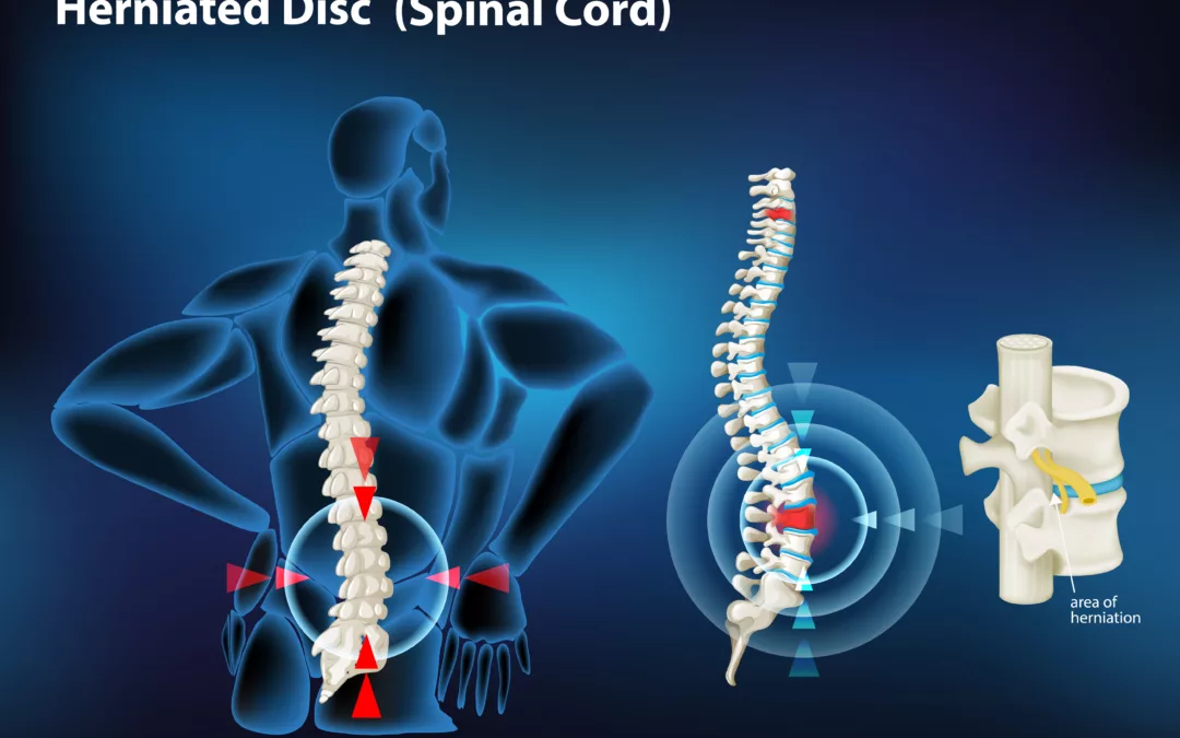 Herniated Disc Treatment in Oakdale, PA | Dr. Josh Slomkowski | Non-Surgical Spinal Decompression Treatment